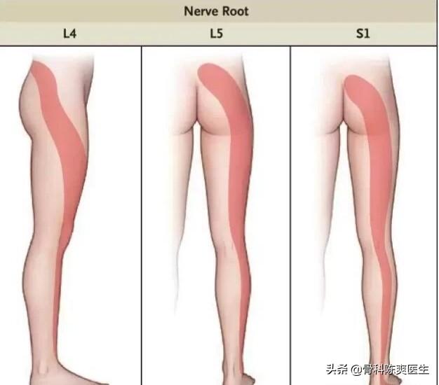 常见脊柱病:哪些病可以引起脊柱源性神经痛？