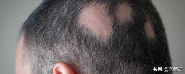 补肾能长头发吗，男人肾虚会导致脱发吗有何依据