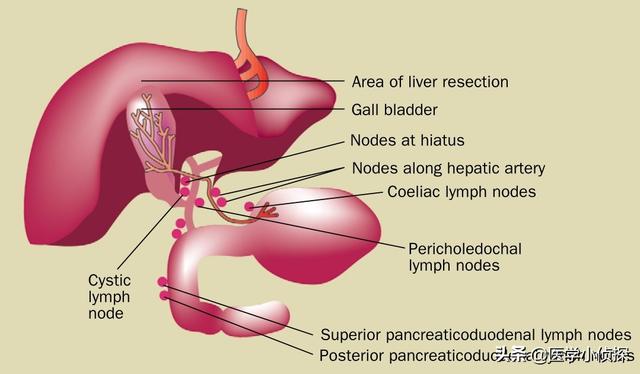 三大抗癌石,胆囊息肉、胆结石会转化为胆囊癌吗？