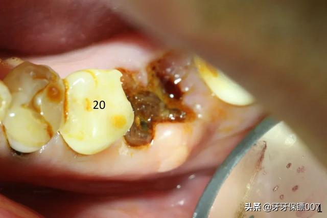 儿童补牙(儿童补牙一般多少钱一颗)