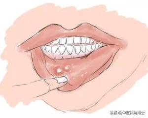 口腔疾病高发人群:你上火口腔溃疡的频率是多少？