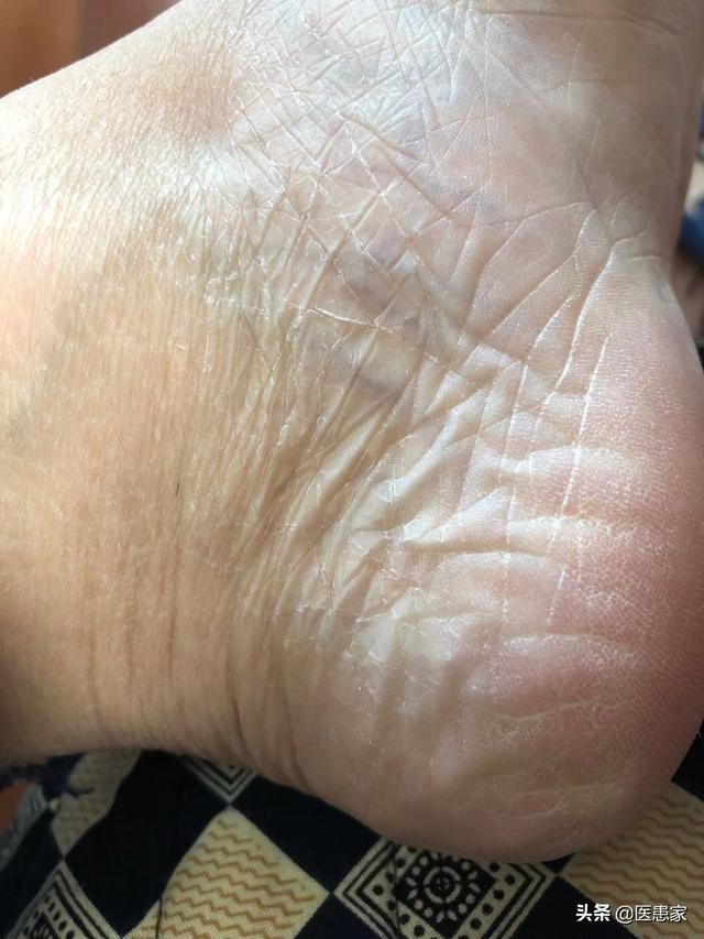 头条问答 脚裂的原因是什么 雪洋大夫的回答 0赞