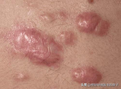 头条问答 - 腋窝下手术后长了一个肉疙瘩怎么去掉?(3个回答)
