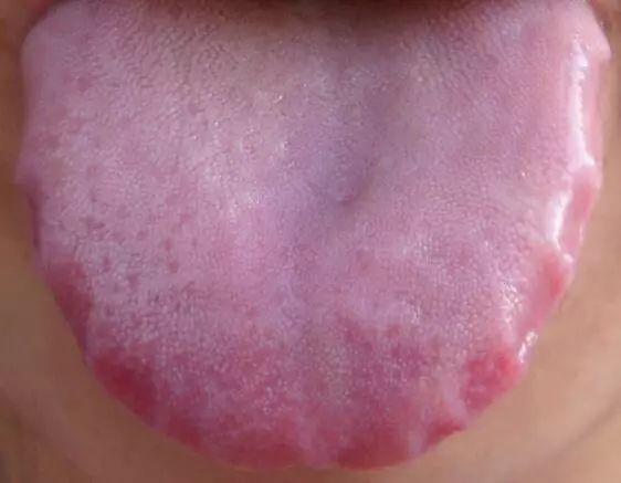 舌头胖大有齿痕，需要怎么调理？插图38