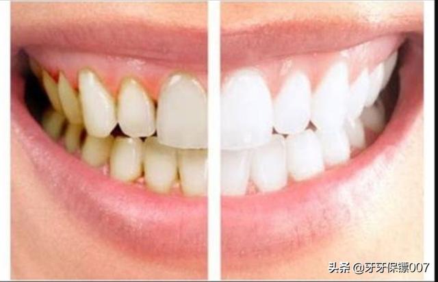 牙结石洗牙多少钱:牙结石洗牙多少钱一颗 有少量牙结石需要洗牙吗？