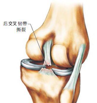 魔兽世界战斗宠物绷带误删:剖腹产的后遗症你们有吗？