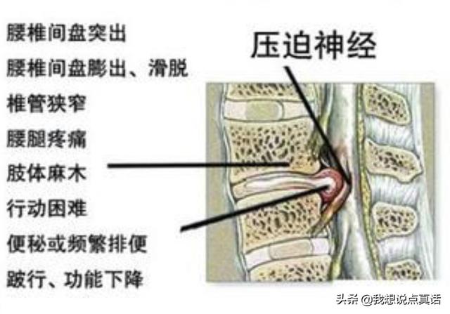 人体腰椎4、5椎部位图片