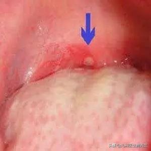 疱疹肺炎严重吗:疱疹病毒性肺炎 带状疱疹长在头上会有后遗症吗？