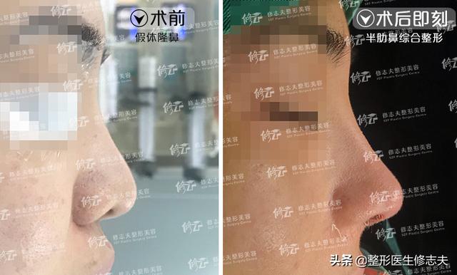 塌鼻梁图片:鼻梁塌、鼻翼宽，塌鼻人如何自救？
