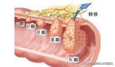 肚疼拉肚子便血是怎么回事:从左侧腹痛到便血到拉肚子有二年了会是肠癌吗？