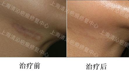 张梓琳腋下现疤痕:女朋友很漂亮也很有钱，但是身上一股怪味，闻到想吐，怎么办？