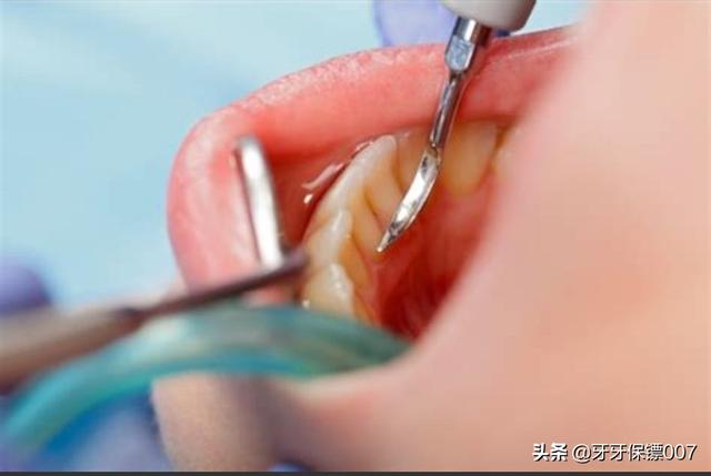 牙结石洗牙多少钱:牙结石洗牙多少钱一颗 有少量牙结石需要洗牙吗？