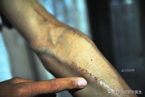 尿毒症有哪些早期症状