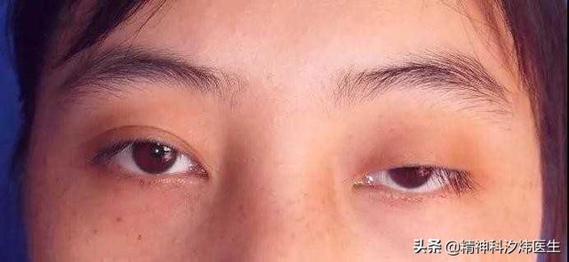 头条问答 - 眼睑下垂三年后复发是重症机无力吗?(1个回答)