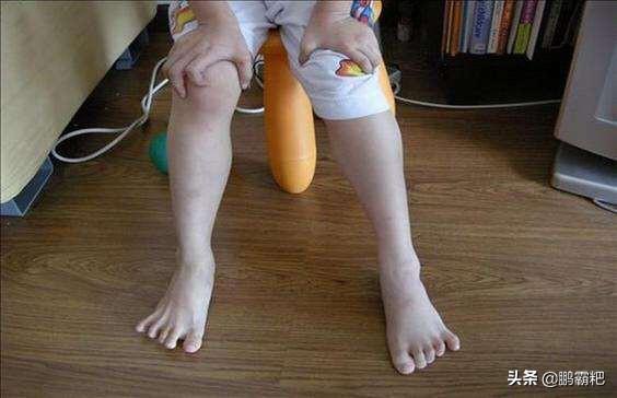 头条问答 - 四岁孩子肌营养不良,小腿肌肉粗大僵硬怎么办?(36个回答)