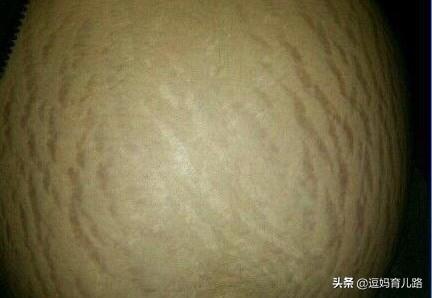 怀孕多久会长妊娠纹？为什么会长妊娠纹？插图43