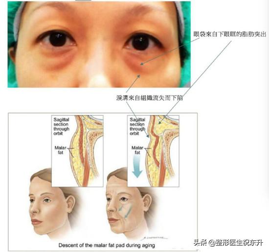 怎样快速去眼袋;怎么消除大眼袋