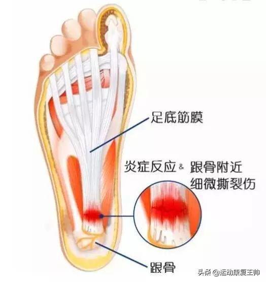 脚后跟疼是咋了，脚后跟疼是怎么回事呢怎么治疗