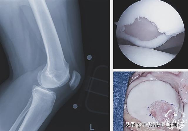 髌骨脱位:孩子做了关节镜手术2个月了，可以跑步和跳绳了吗？