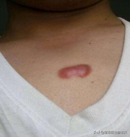 疤痕性体质(疤痕性体质是什么原因导致的)