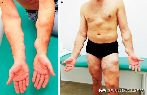 头上长包会得癌吗:脂肪瘤会变成恶性肿瘤吗？