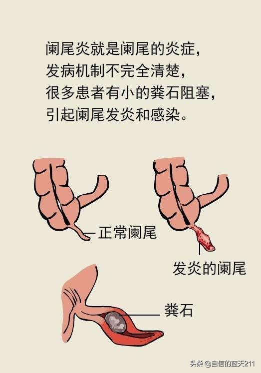 头条问答 - 患有阑尾炎病者有哪些症状?需要注意哪些事项?(1个回答)