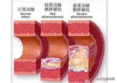 什么是四招一试，血管硬化不是小事，把血管变软，4个方法值得一试，是哪4个方法