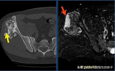 胫骨结节骨软骨病治疗:胫骨结节骨软骨炎怎么办？