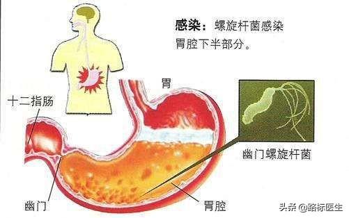 红酒杀幽门螺杆菌吗，为什么幽门螺杆菌在胃内，但是吃的药多是通过血液循环杀灭病菌的？