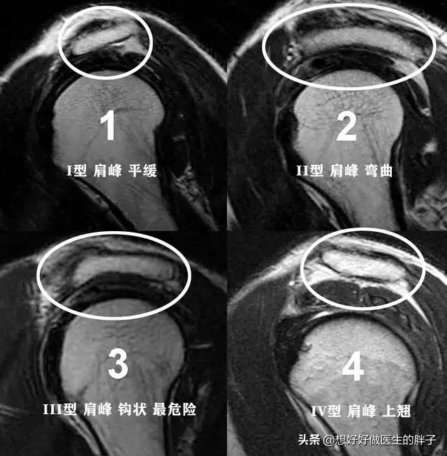 拔罐进风疼痛肩膀疼痛怎么办?肩膀拔罐拔出水泡是怎么回事