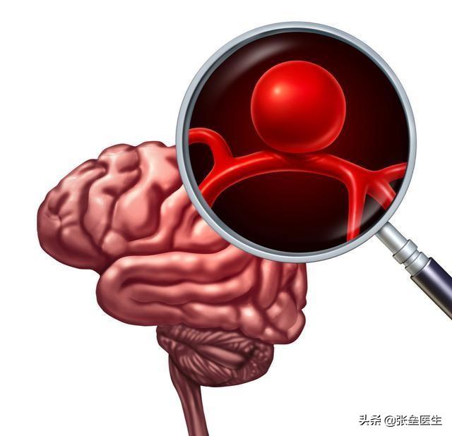 脑溢血发病前有什么征兆吗