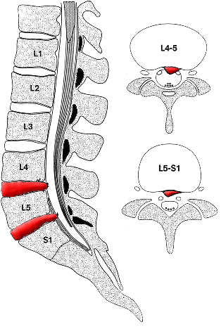 45节腰椎间盘位置图图片