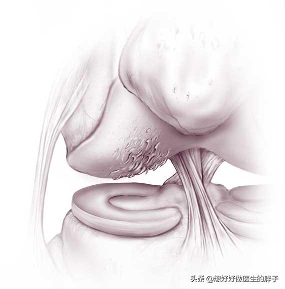 膝盖软骨磨损微创手术费用:膝关节前交叉韧带的损伤与治疗？