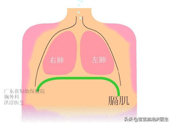 膈疝宝宝的恢复过程:左侧膈疝？膈疝是什么病？