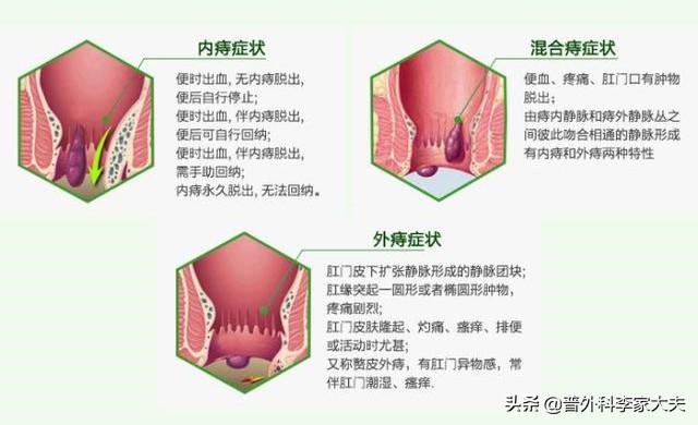 痔疮是怎么得的图片