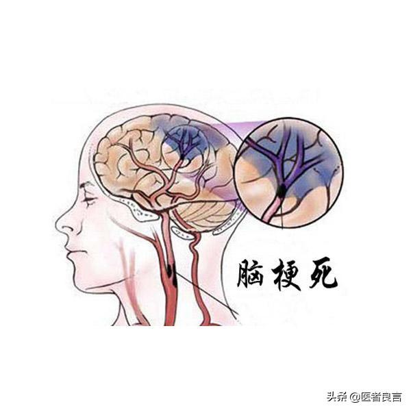 左侧小脑室旁脑梗塞严重吗：左侧侧脑室旁脑梗塞严重吗