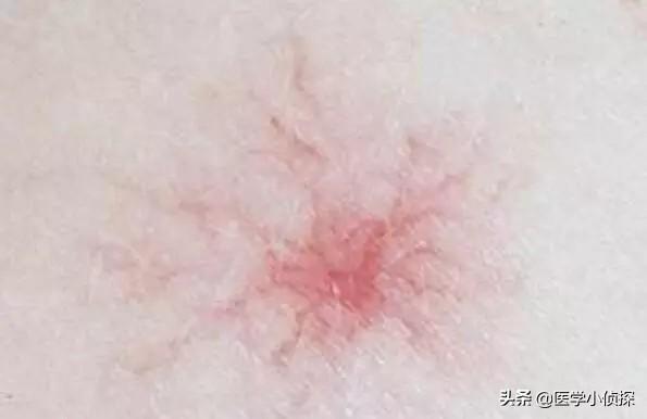 蜘蛛痣图片:蜘蛛痣图片初期症状 身上有小红痣，千万别大意，是大病的预警信号吗？