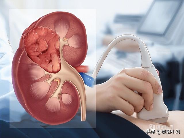 肾癌晚期(肾癌晚期)