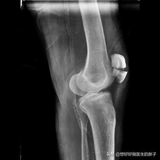 髌骨骨折十个月以后出现膝关节疼痛的情况是比较常见的,主要见于三种
