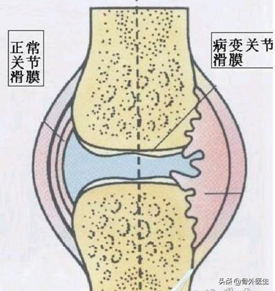 劳损性关节炎能治好吗:创伤性关节炎形成的原因有哪些？