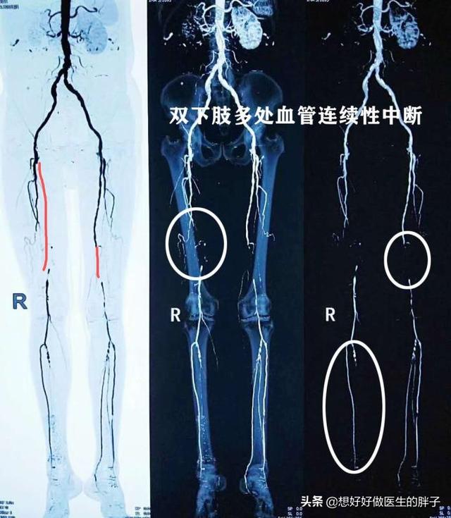 间歇性跛行:间歇性跛行 关节炎会引起间歇性跌行吗？