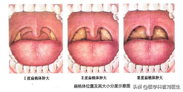 扁桃体分度图图片