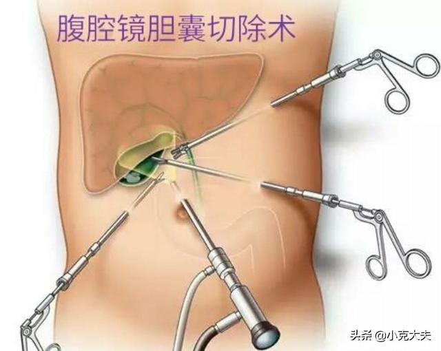 腹腔镜手术后注意事项:腹腔镜切除输卵管手术后注意事项 宫外孕腹腔镜手术后多久可运动？