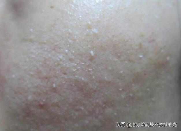 毛孔芝麻:毛孔里反复挤出来的“小米粒”，到底是什么东西？