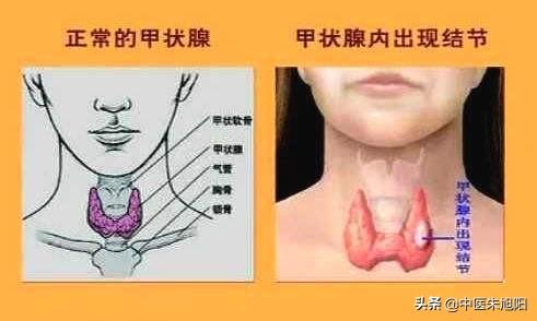 头条问答 嗓子老有异物感做喉镜没事怎么办 8个回答