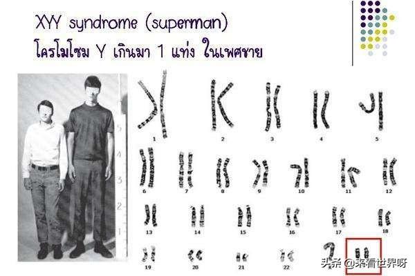 性染色体异常(如xxy型,xyy型)对个人性格的影响是什么?