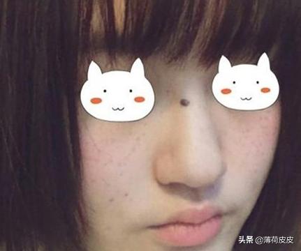 可不可以请大家推荐一下祛斑的方法？
