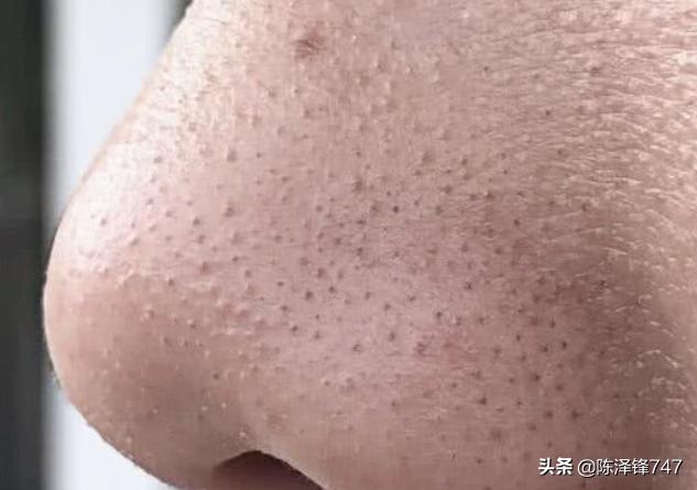面部螨虫图片:脸上毛孔如“橘皮”，越来越粗，跟什么因素有关呢？螨虫可能吗？