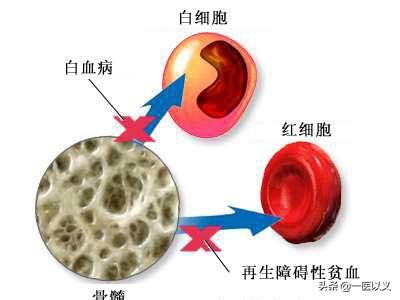 心肺病:心肺病是什么症状 血常规正常，可以初步排除哪些疾病？