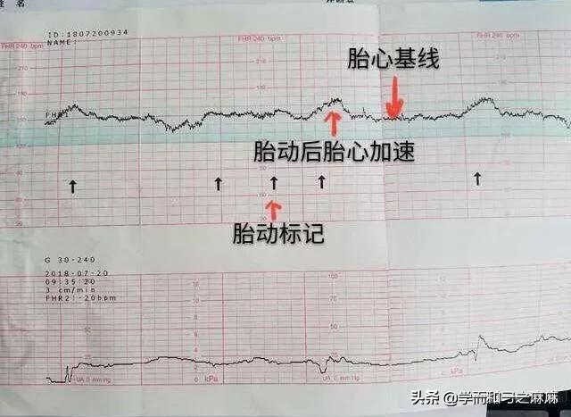 产检第一次做胎心监护,整体胎心特别高！是什么原因？